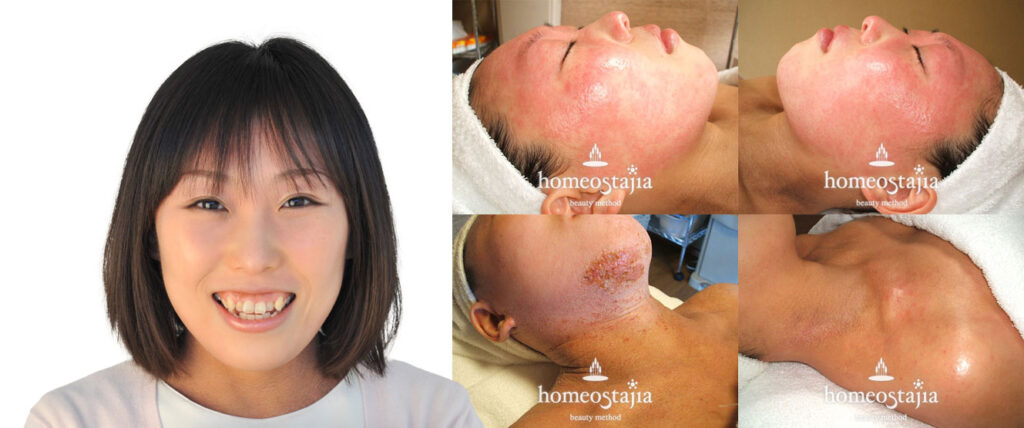 アトピー性皮膚炎／ステロイドの長期多量使用によるステロイド性皮膚炎／先天性喘息・帯状疱疹